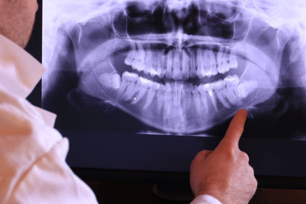 Best Emergency Dental Extractions in Munster, IN